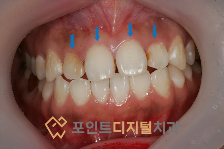  [탕정치과]  심미보철 6년 경과 사진 / 천안 아산
