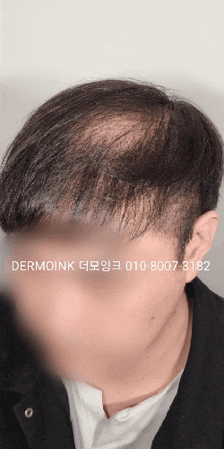  강남 두피 페인팅 후기, 텅 빈 정수리와 가르마가 신경 쓰여 외출이 망설여지나요?