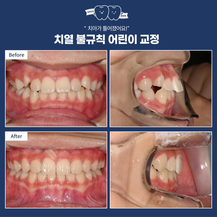  하남 초등학생 부정교합, 인비절라인 퍼스트로 2차 교정 없이 끝낸 10세 후기