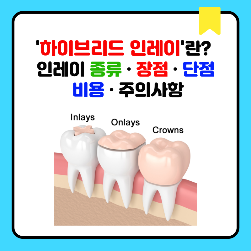 '하이브리드 인레이'란? 인레이 종류 · 장점 · 단점 · 비용 · 주의사항