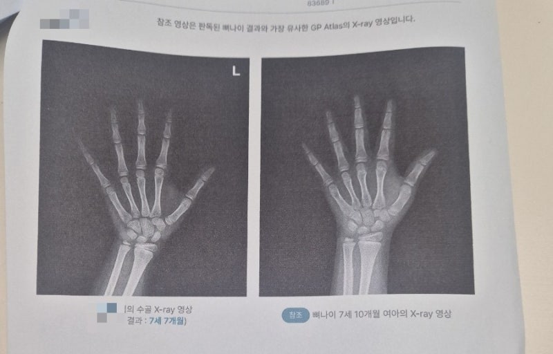 (은평구)손 엑스레이(성조숙증) 성장판 검사 - 활기찬정형외과