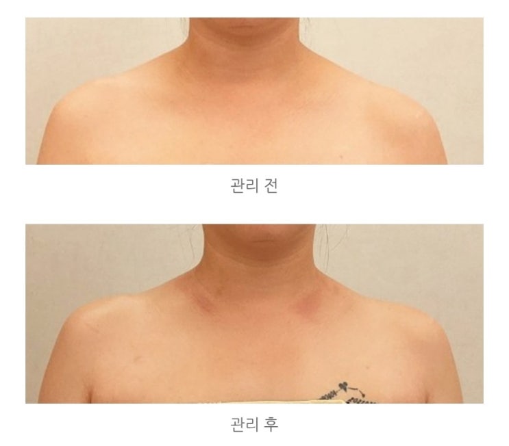  울산 피부관리 남구 삼산동 아뜰리에드스킨 제니어깨 라운드숄더 후기