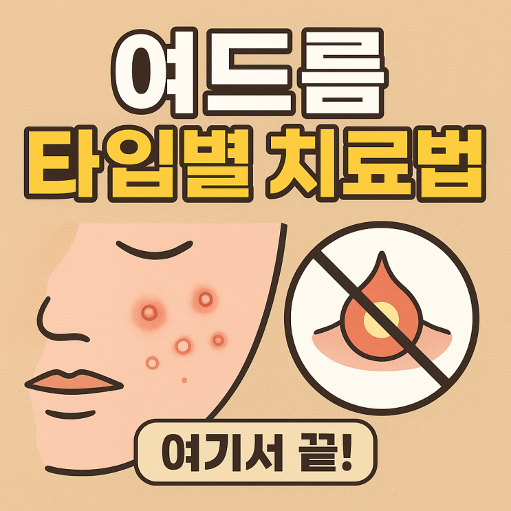   여드름 종류에 따라 달라지는 치료법 완전 정리!