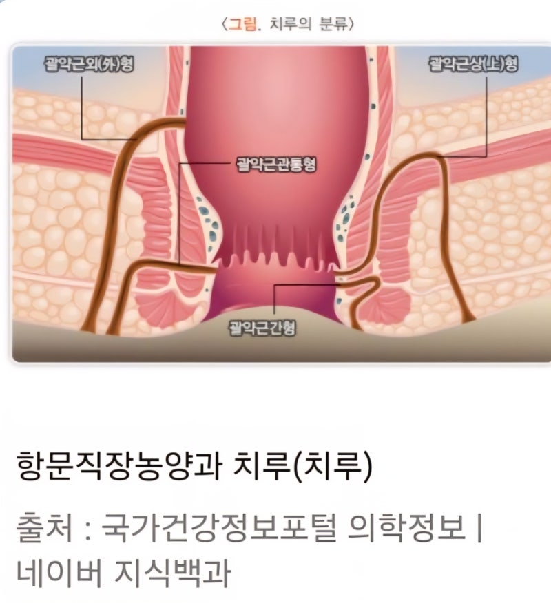 항문관과 항문 주변 피부 사이에 터널이 생겨 구멍으로 분비물이 나오는(치루)