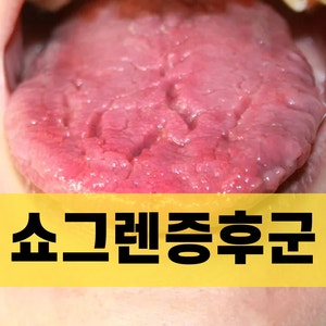 쇼그렌증후군 증상 구강건조증 원인 치료