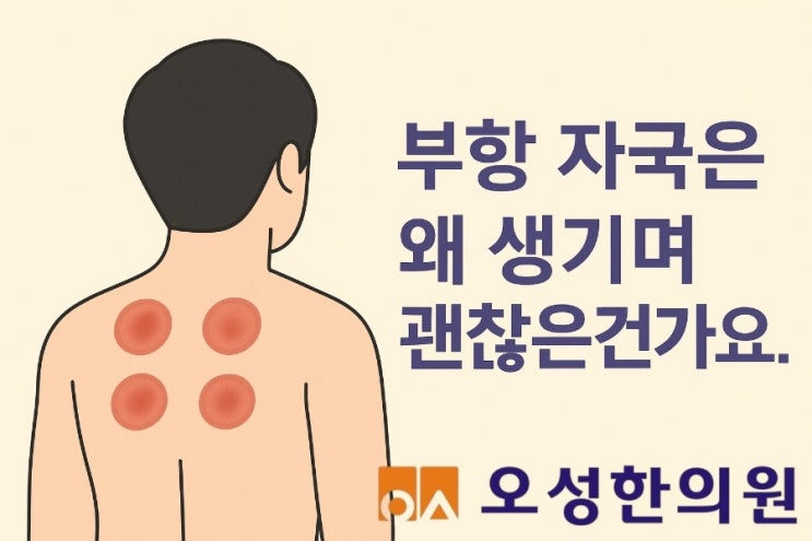  부항 자국은 괜찮은 건가요? 파주 피빼주는 봉일천 오성한의원
