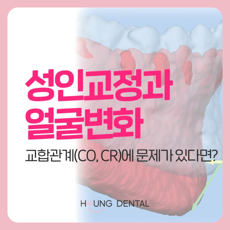  턱의 회전이 일어나는 반월동 치과의 사례는?