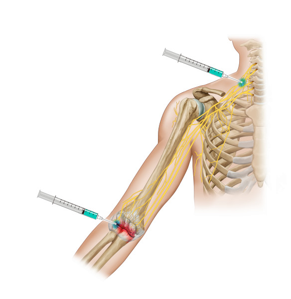  [프로젝트] 연관통(Referred Pain) 시각화: 팔꿈치/무릎 신경 주사 치료 일러스트 제작 사례