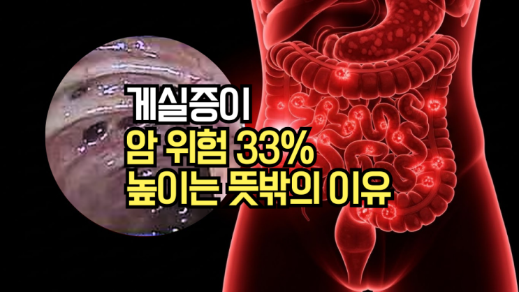  게실염 증상, 맹장염과 헷갈린다면? 대장 게실증 원인과 위험성, 이것만 확인하세요!