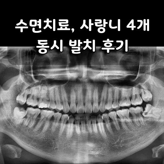  신촌역에서 수면치료로 사랑니 4개 동시에 발치한 후기