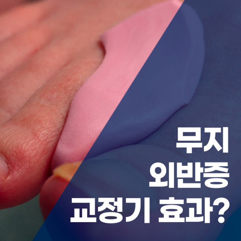 인천무지외반증 교정기 효과, 정말 수술 없이 나을 수 있을까? (정형외과 전문의 답변)