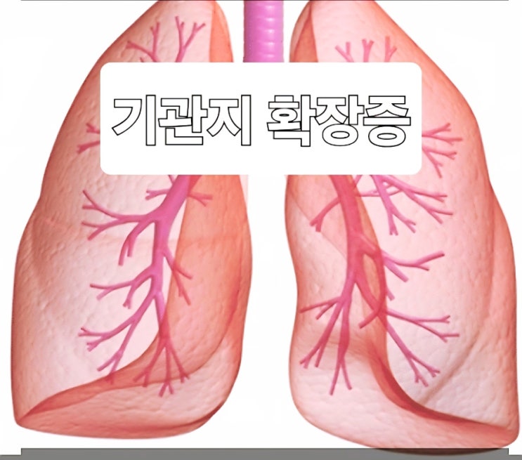  "아침마다 누런 가래가? 기관지 확장증 증상과 관리법 총정리"