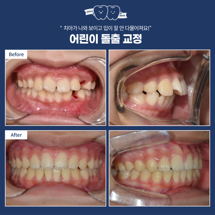  하남 어린이 돌출입 교정, 단순히 치아만 넣는 게 아닙니다 (입 호흡 vs 코 호흡)