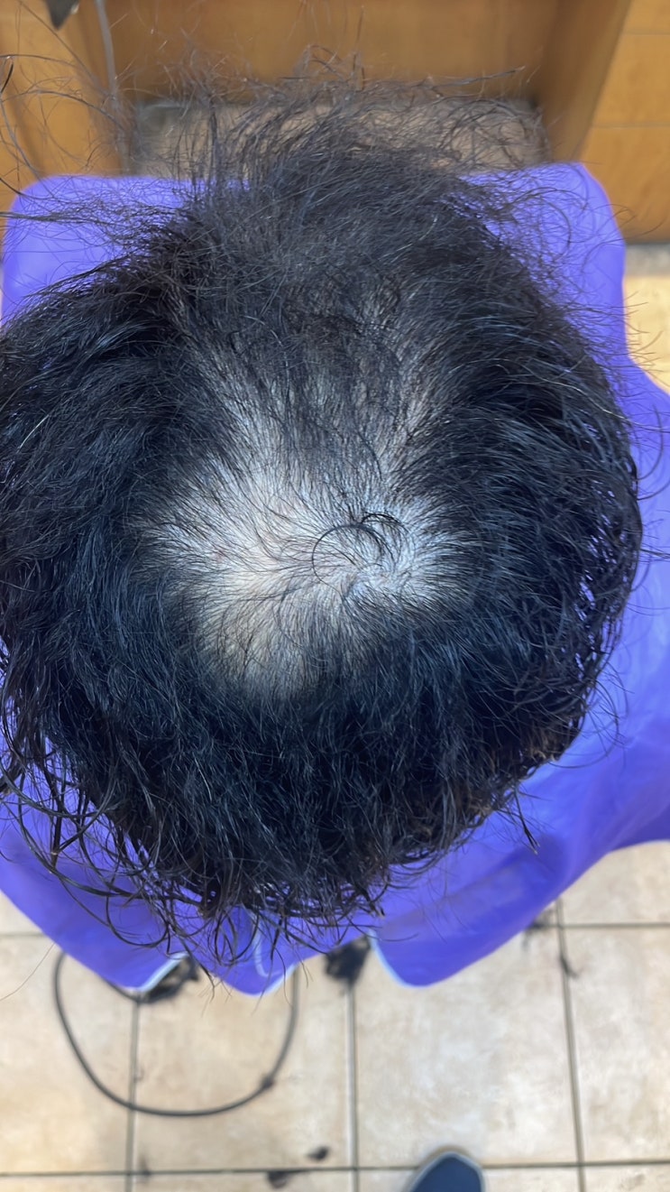  남자 정수리 ‘뻥’ 뚫렸다면 지금 심각합니다 하지만… 르네시떼미용실 부산사상점이면 ‘1회차에 반전’ 납니다** / 중구서구동구영도구부산진구동래구남구북구해운대구사하구금정구강서구연제구