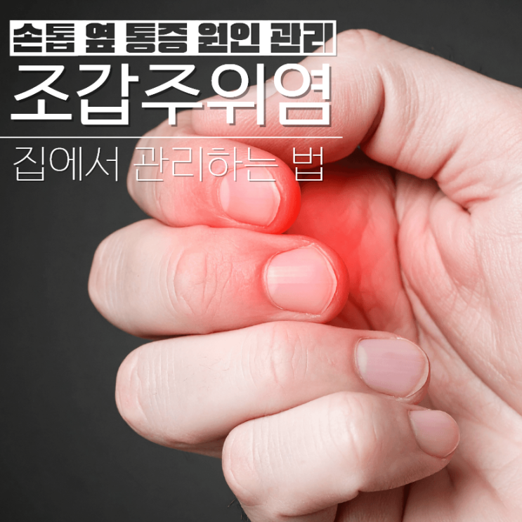  조갑주위염 손톱 옆 통증 이유? 연고