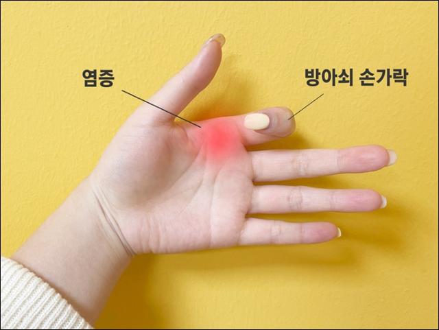  손가락이 딱 걸리고 아픈 방아쇠수지증후군 왜 생길까 증상·원인·치료 총정리
