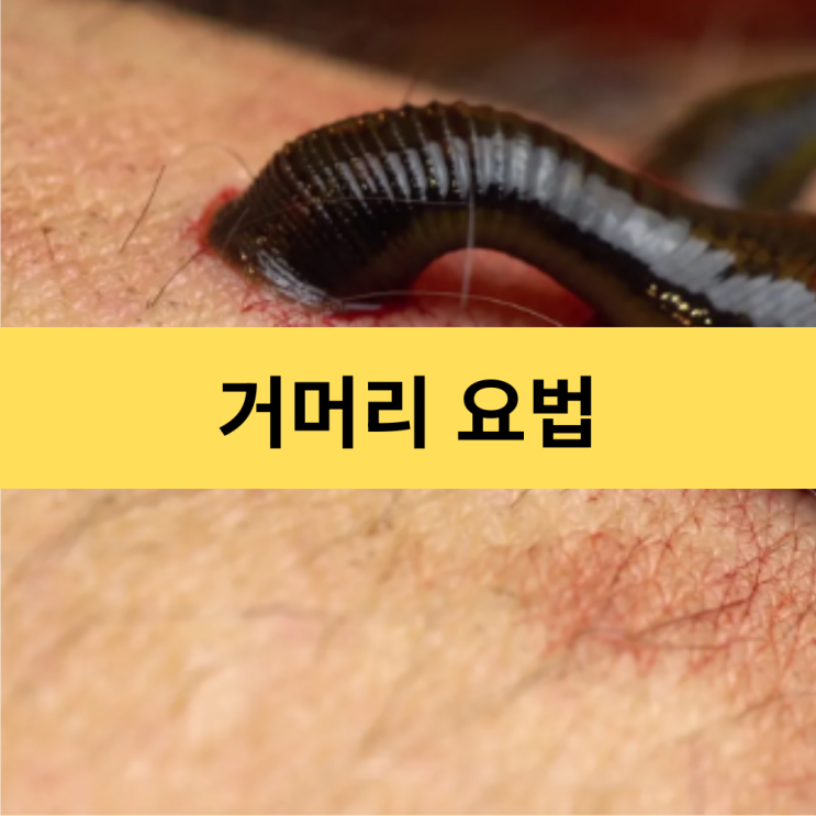  거머리 요법 | 현대 의학에서 재조명받는 거머리의 비밀과 실제 활용 방법 | 히루딘