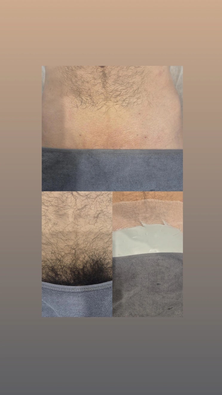  인그로운 헤어까지 무료로 제거해 드리는 남자 브라질리언 왁싱 전문, 영등포 남자 왁싱샵 "청춘케어"