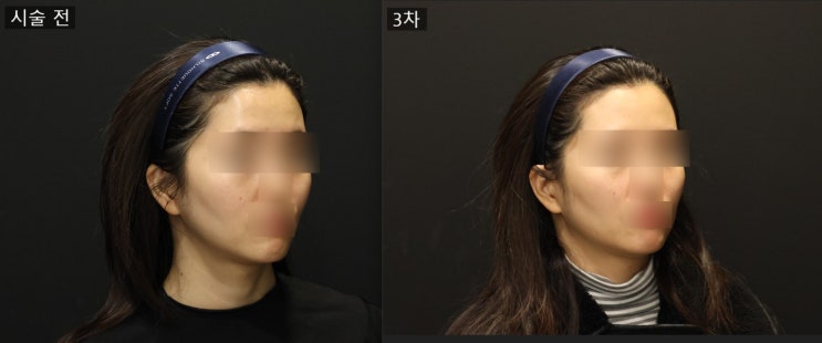  [스컬트라] 스컬트라 팔자주름 광대라인 눈밑꺼짐 3차 후기