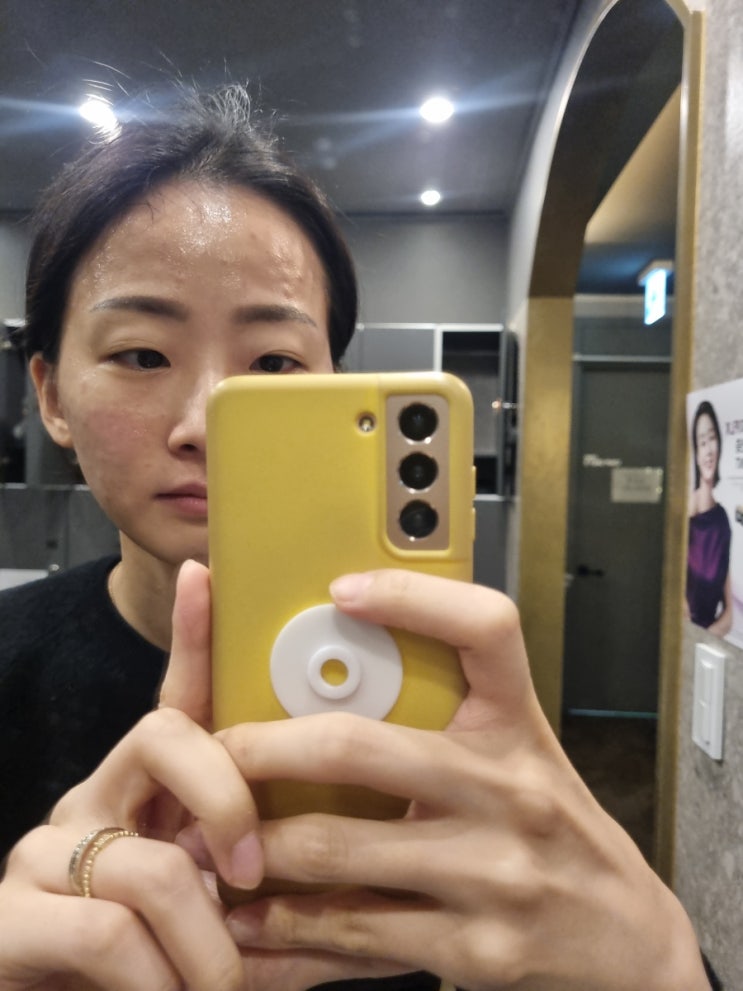  앤봄의원에서 인생 첫 물광주사+스킨보톡스 조지고 왔댜-