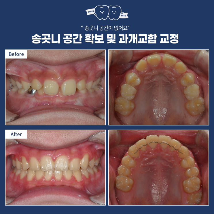  "송곳니 날 공간이 없대요" 발치 없이 해결한 양평 어린이 교정 골든타임