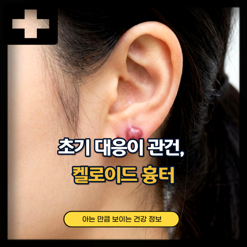 켈로이드 흉터 원인 제거 주사