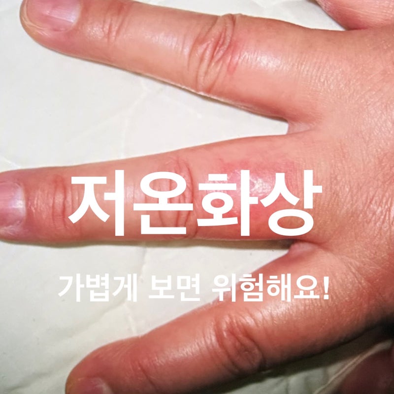 대구 저온화상 치료 증상 예방법까지 칠곡 장재원 피부과 의원