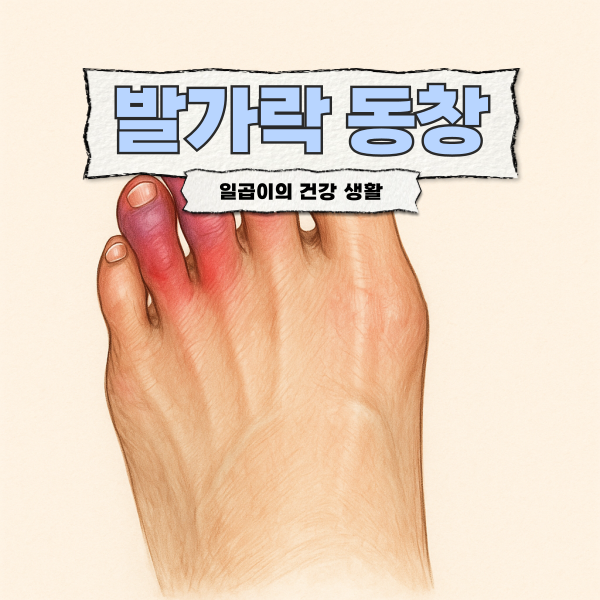 겨울철 발가락이 따끔하고 간지럽다? 발가락 동창 증상부터 치료 알아보기
