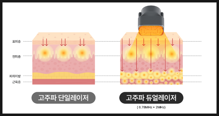  여의도역 피부과 세르프 300샷 600샷 선택 기준은