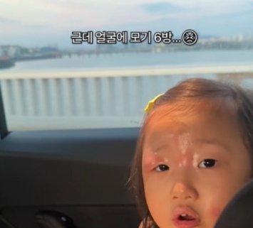   한지혜 딸, 모기 6방에 눈이 퉁퉁! 엄마 한지혜 "진짜 열받아" 속상함 토로한 사연
