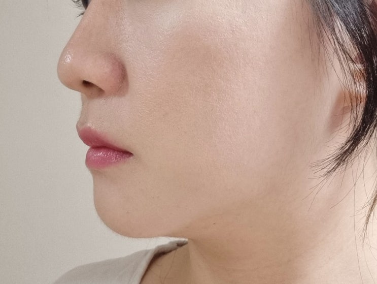  동탄 반송동피부과 리쥬란hb 효과 통증 가격 후기
