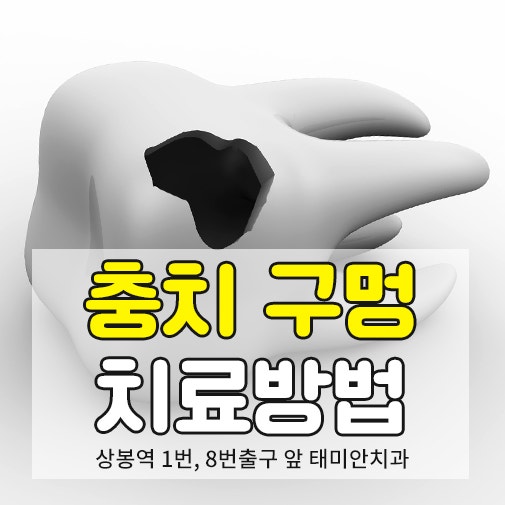 치아 이빨 구멍 메우기 충치 치료 비용과 종류는