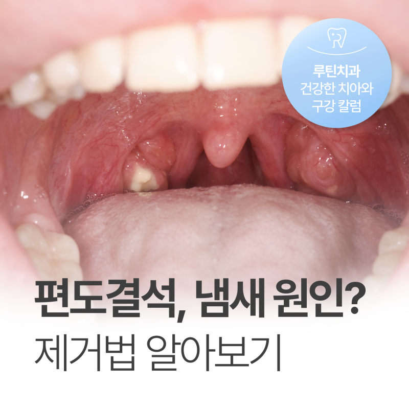 편도결석 빼는법 셀프제거 가글도 가능?