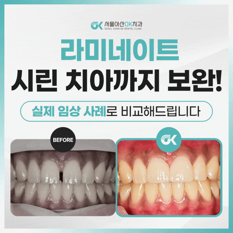  [임상사례]하남시치과, 앞니 라미네이트와 신경치료