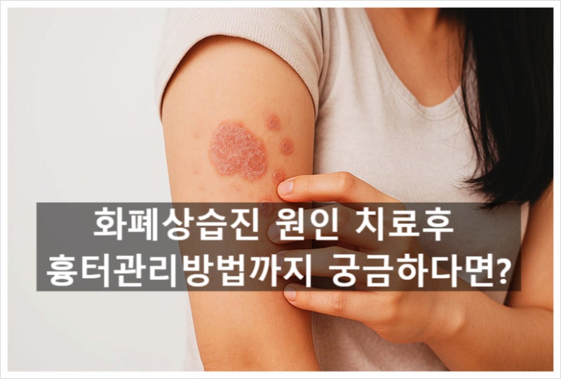 만성습진 화폐상습진 원인 치료후 흉터관리방법까지 해결하려면?
