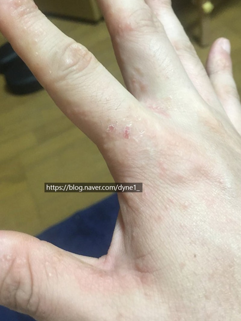 손등 한포진 수포 터졌을 때 대처방법