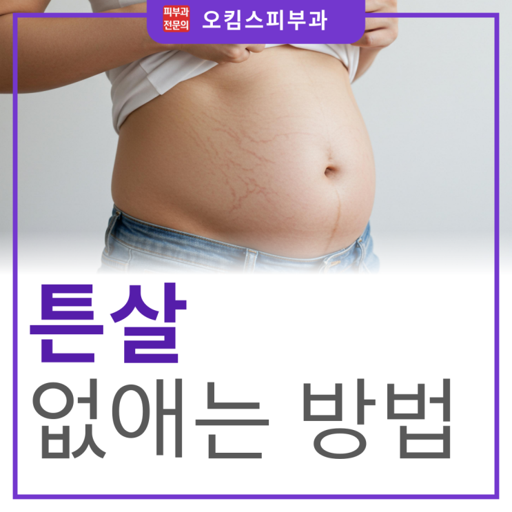  마두역 피부레이저 하얀 빨간 튼살 없애는 법, 이것만 기억해두세요.
