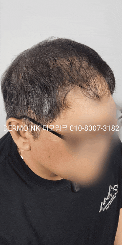  강남 두피 커버 솔루션, 거울 볼 때마다 움츠러드는 정수리 탈모 이제는 남의 일