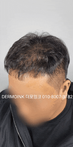  수원 두피 페인팅으로 자연스러운 젊음을 되찾으세요! 숱 없는 정수리, 가르마가 신경 쓰이나요?