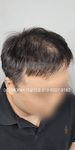  수원 영통 두피 탈모, 꼭 알아야 할 QnA 핵심만 모았습니다