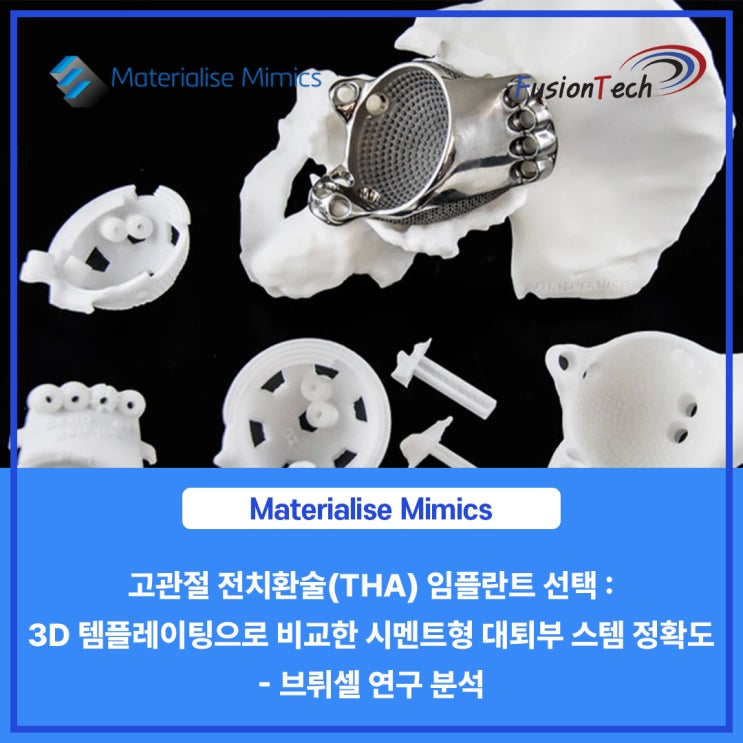  [Materialise S/W] 고관절 전치환술(THA) 임플란트 선택: 3D 템플레이팅으로 비교한 시멘트형 대퇴부 스템 정확도 - 브뤼셀 연구 분석