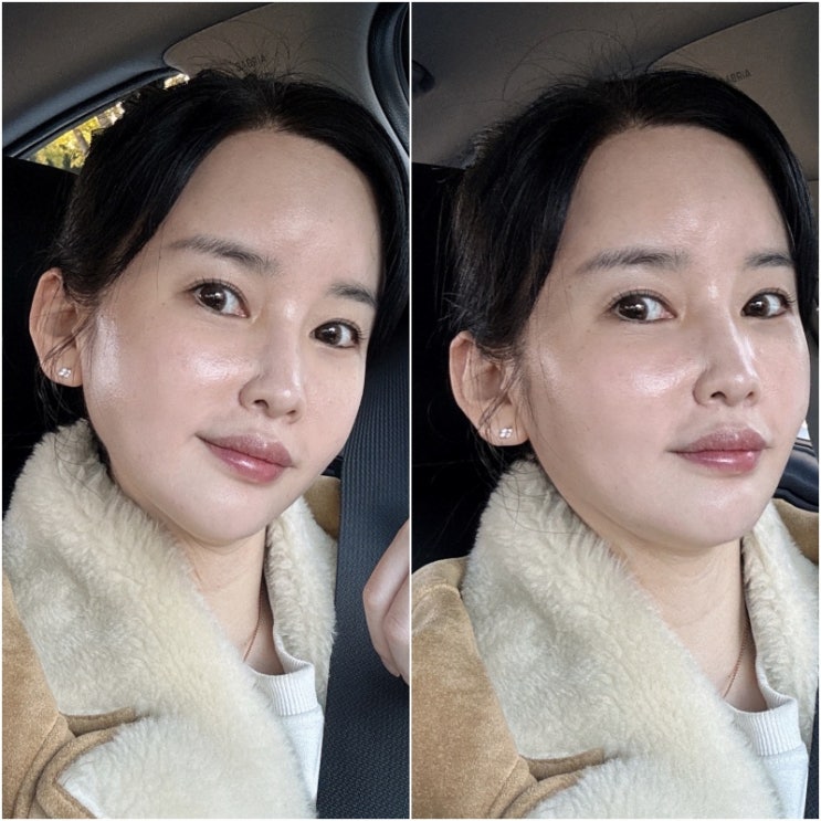  해운대 피부과 효과 빠른 고현정 리프팅 텐써마 300샷 후기!