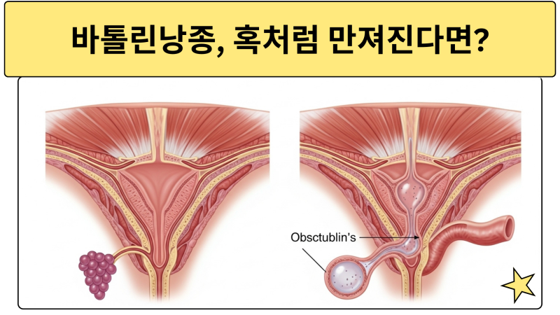 바톨린낭종 원인 증상, 통증 없다고 방심 금물! 90%가 모르는 감염 메커니즘