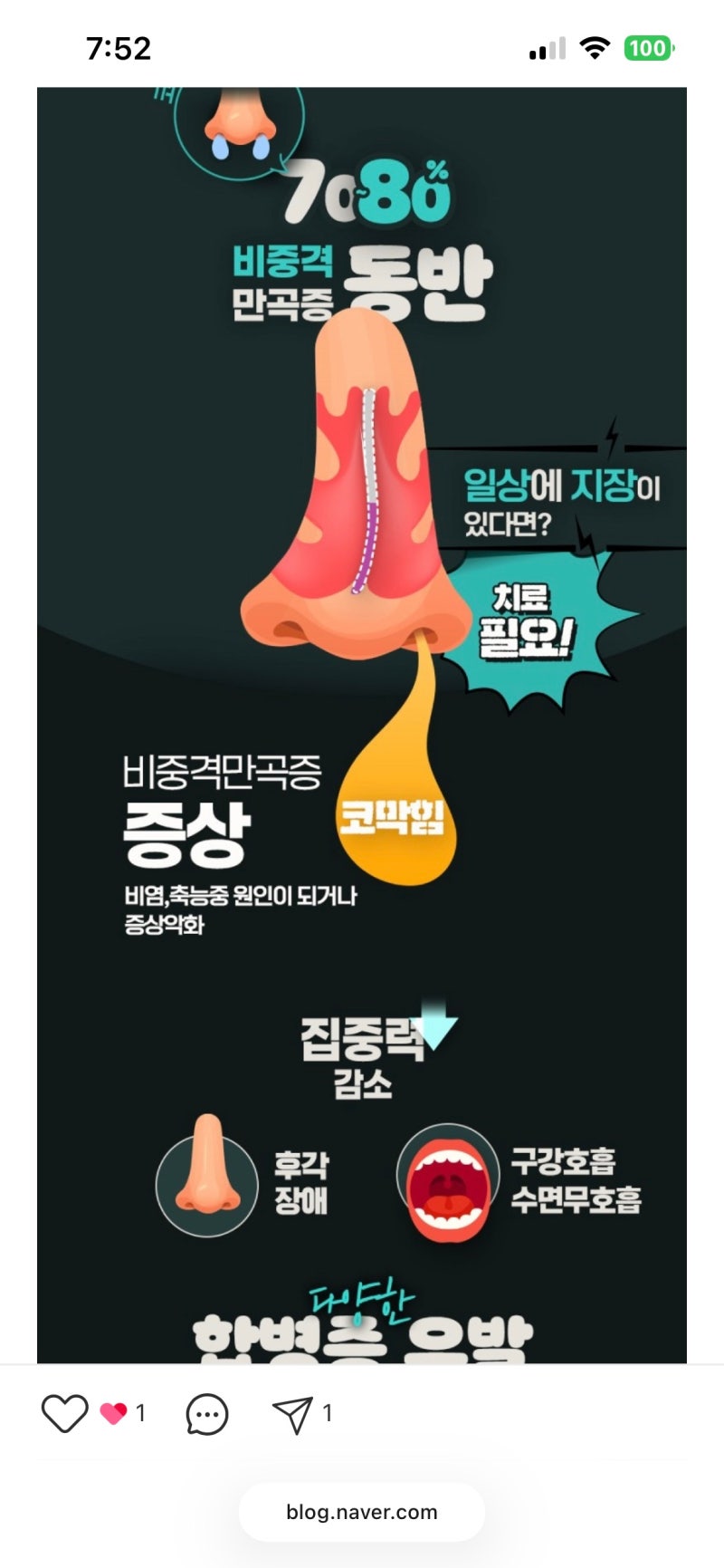 죽다살아난 비염코수술 비중격만곡증 후기