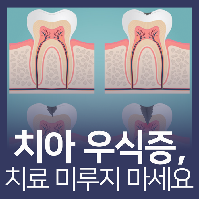 치아우식증 뜻·치료 총정리│초기와 진행, 치료 범위가 완전히 달라집니다
