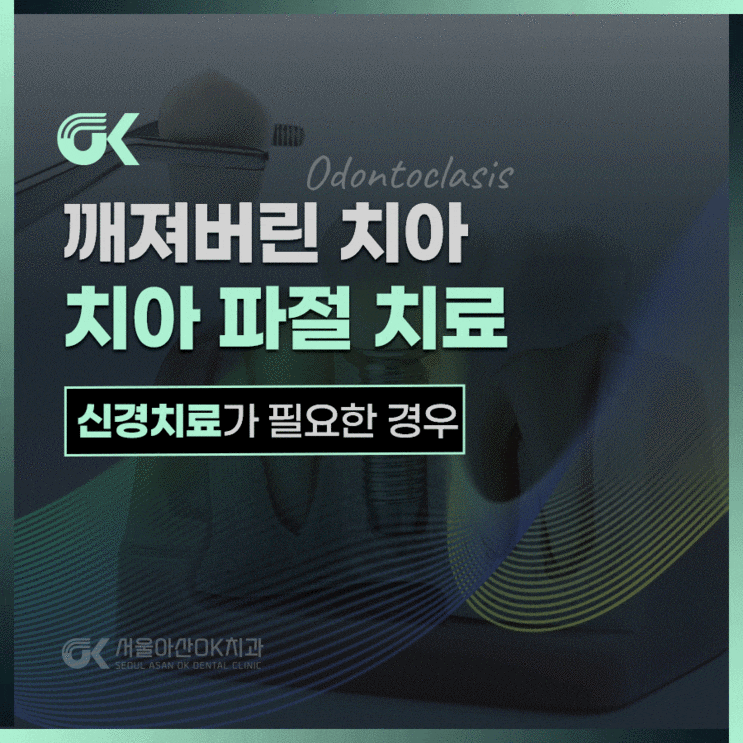  하남신경치료, 깨진 치아와 신경치료 필요한 경우