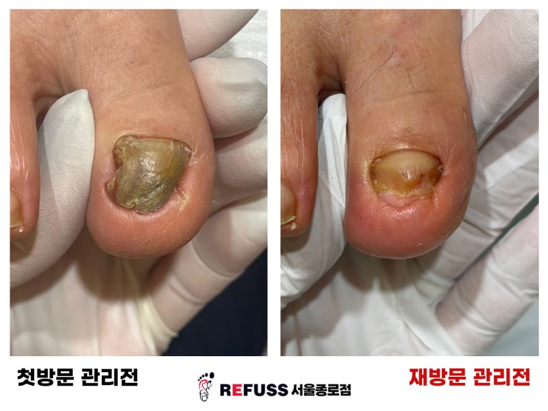 발톱도 스케일링을 받는다? 변형된 발톱 관리 잘하는 곳 ::레푸스 종로