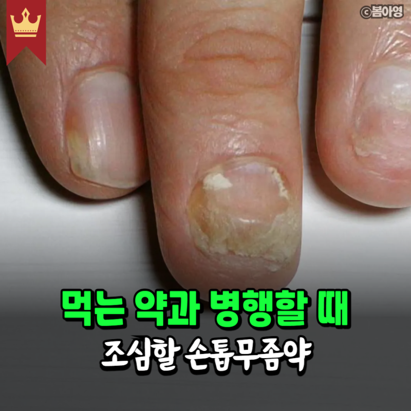 먹는 약과 병행할 때 조심할 손톱무좀약