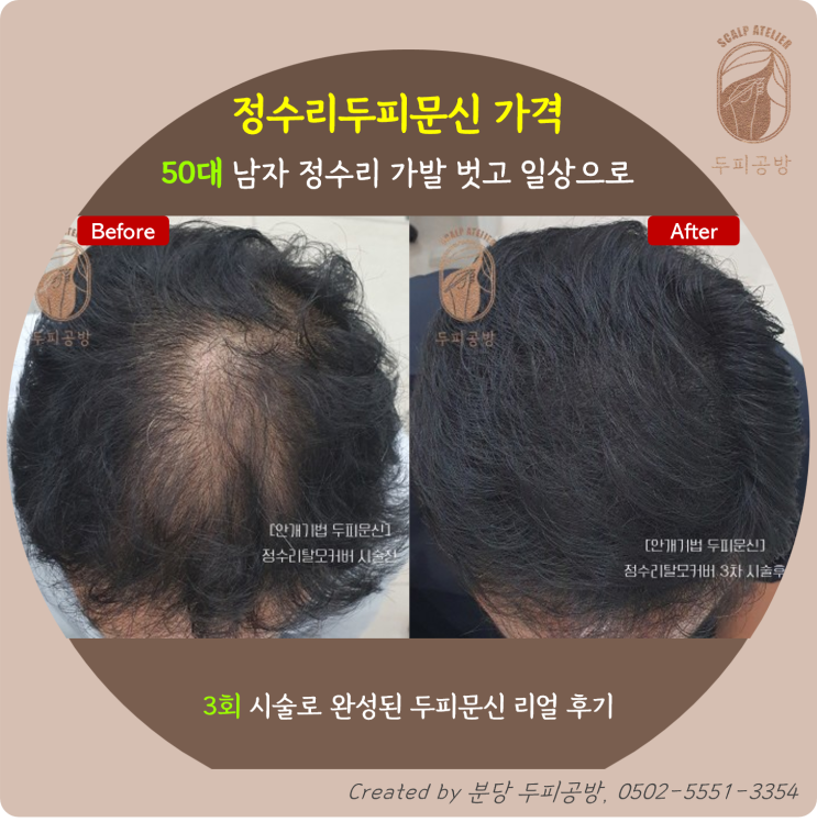 [정수리두피문신 가격] 50대 남성 가발 벗고 일상으로 | 분당두피공방 리얼후기