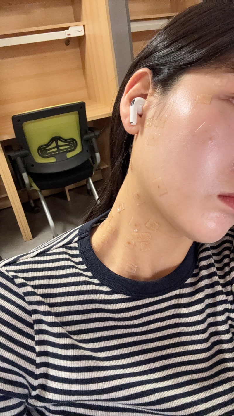 [전주] 편평사마귀제거 레이저 vs 침 한의원 내돈내산 후기 2주과정